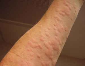 Remedy for Hives