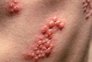 Shingles or Herpes Zoster