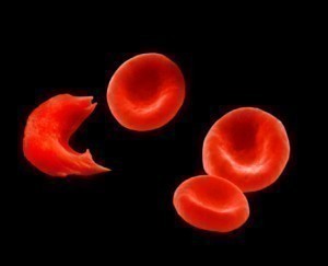 Sickle Cell Disease