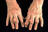 What Causes Gout?