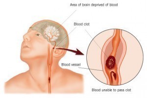 Symptoms Before a Stroke