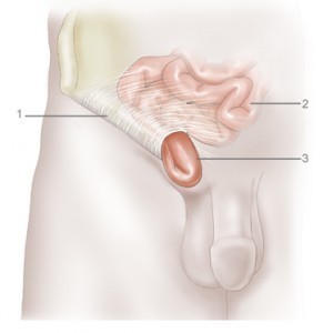 Symptoms of Hernia