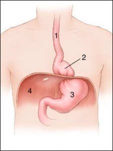 Symptoms of Hiatal Hernia