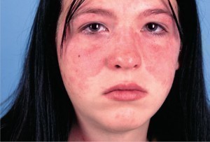 Symptoms of Lupus