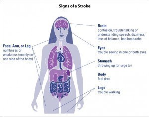 Symptoms of a Minor Stroke