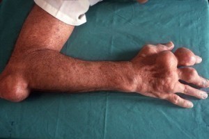 Treatment for Gout