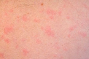 Treatment for Hives