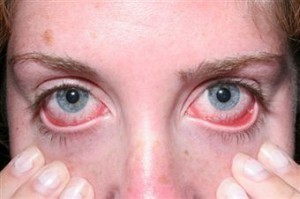 Treatment for Pink Eye