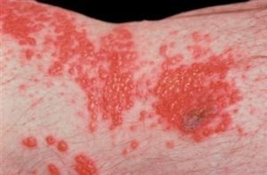 Treatment for Shingles