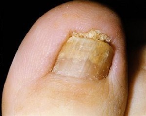 Treatment for Toenail Fungus