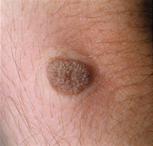 Treatment for Warts