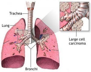 Walking Pneumonia Symptoms