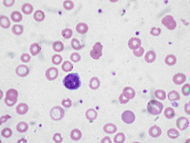 What Causes Anemia?