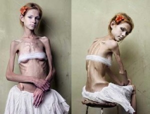 What Causes Anorexia?