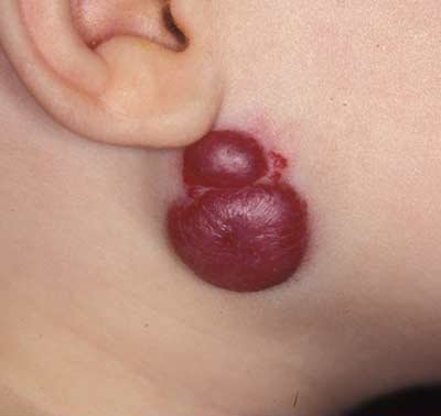 Hemangioma Pain