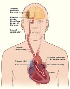 What Causes a Stroke?