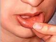 What Causes Canker Sores?