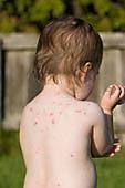 What Causes Fifth Disease?