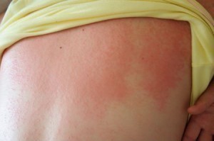 Heat Rash Symptom