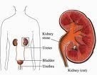 What Causes Kidney Stones?