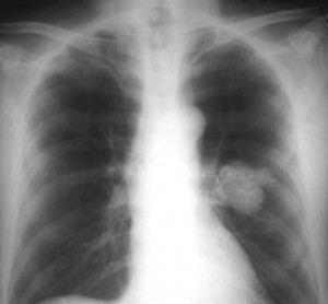 What Causes Lung Nodules?