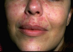 What Causes Lupus?