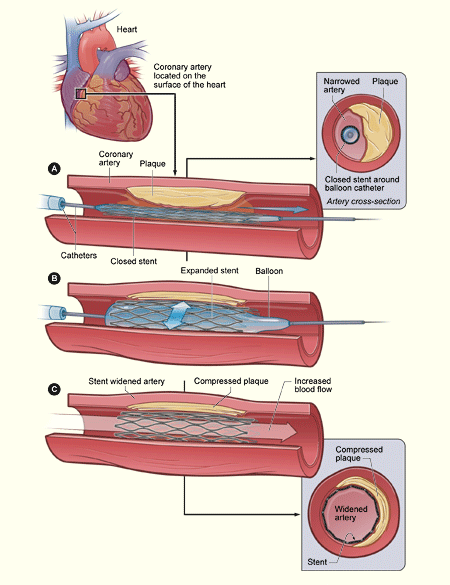 Heart Stent Pain