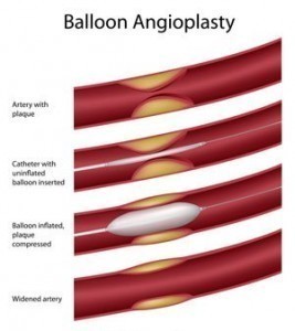 Symptoms of Coronary Blocked Arteries