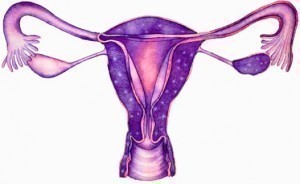 Pelvic Inflammatory Disease