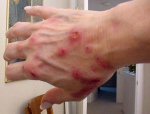 Morgellons Disease